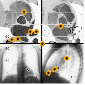 Adactylia unilateral dominant