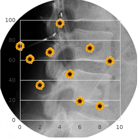 Davenport Donlan syndrome